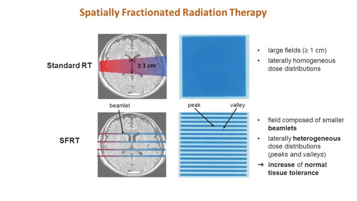 Success Story - RADIOTHERAPY