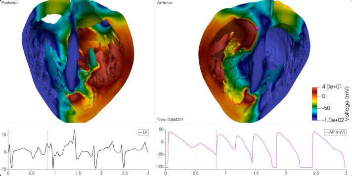 Drug-induced arrhythmia on a normal human heart during fast sinus pacing.